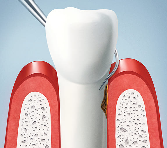 歯冠長延長術（クラウンレングスニング）STEP1