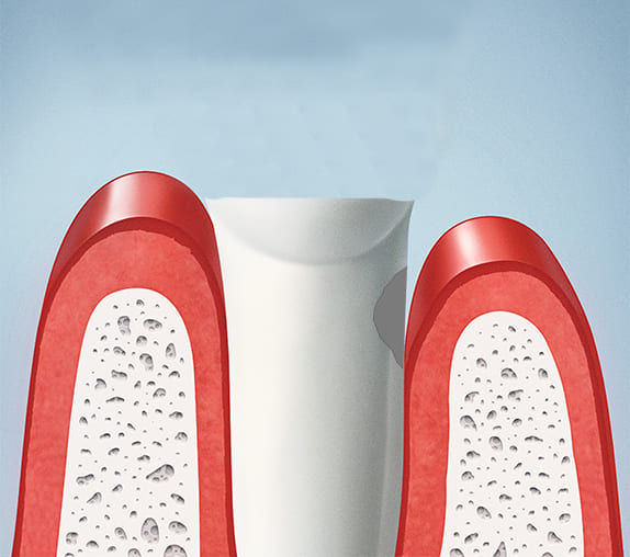 歯冠長延長術（クラウンレングスニング）STEP3