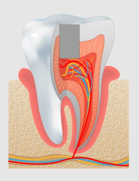 MTAセメントによる非抜髄治療の術後