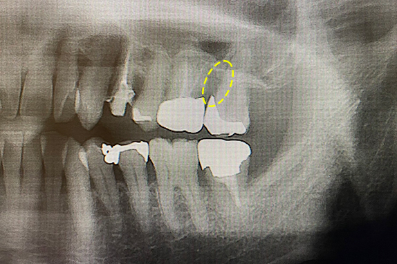 歯周再生療法+インプラント治療術前