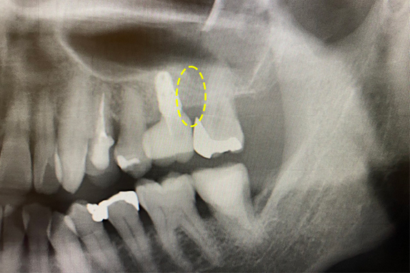 歯周再生療法＋インプラント治療術後