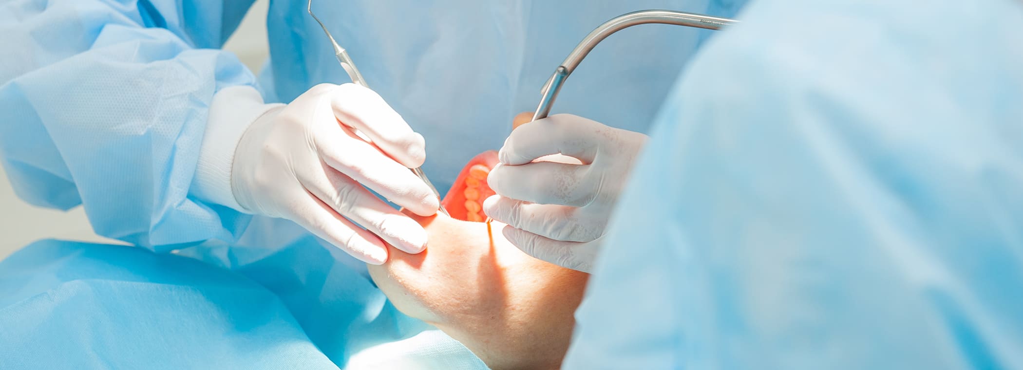 インプラント治療