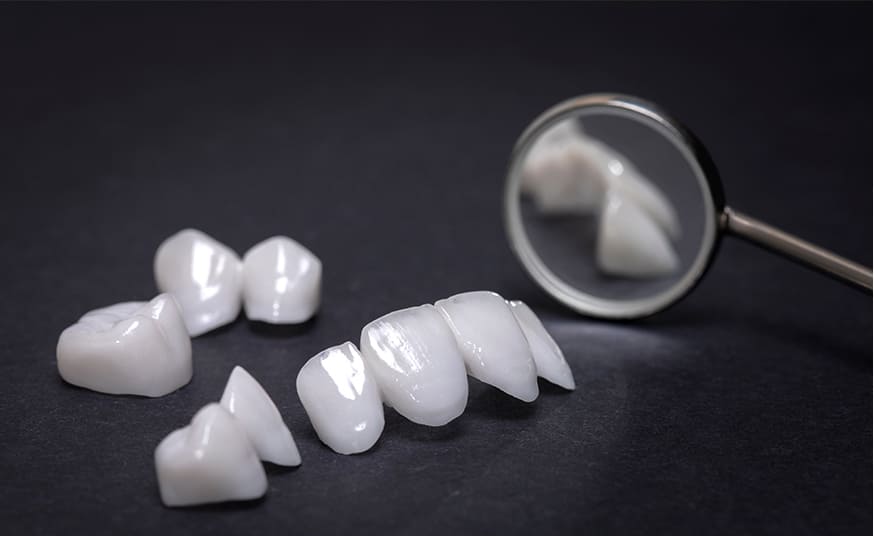 金属アレルギーに効果的なセラミック治療