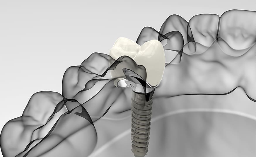 周囲の歯を守るインプラント