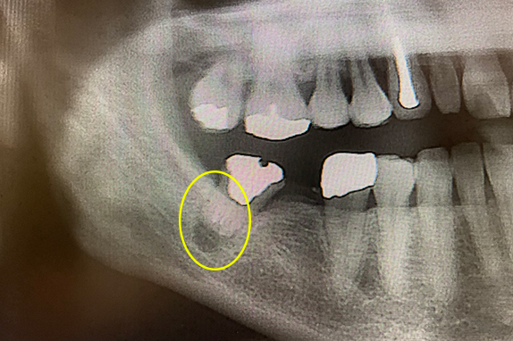 マイクロエンド＋インプラント治療術前