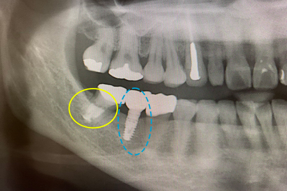マイクロエンド＋インプラント治療術後