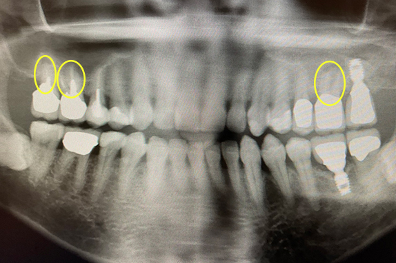 マイクロエンド+歯周基本治療術前