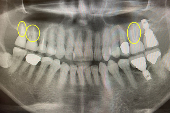 マイクロエンド+歯周基本治療術後