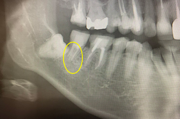 マイクロエンド術後