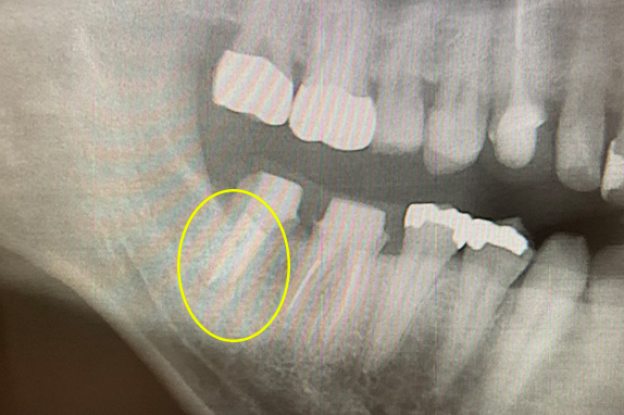 マイクロエンド＋インプラント治療術後