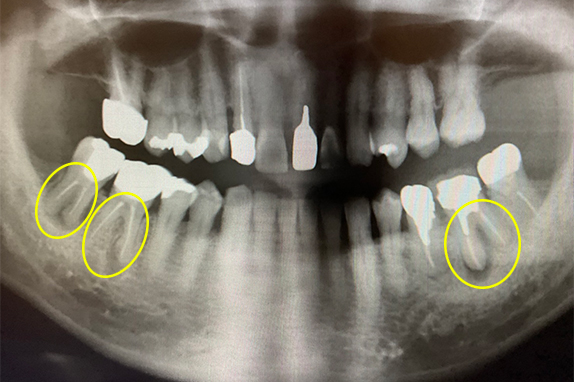 マイクロエンド・歯周再生療法術前