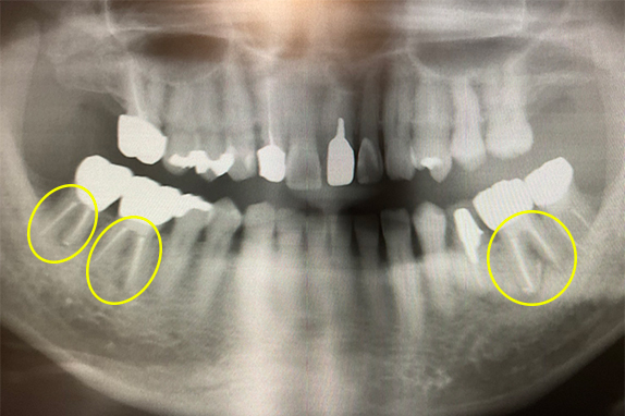 マイクロエンド・歯周再生療法術後