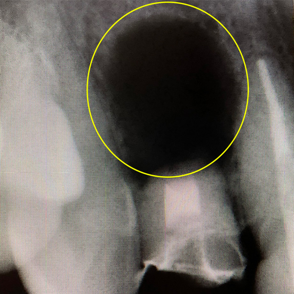 マイクロエンド、歯根端切除術術前