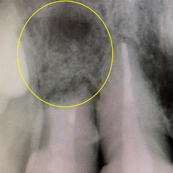 マイクロエンド、歯根端切除術術後