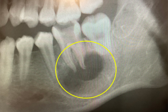 マイクロエンド、歯根周囲掻爬（歯周外科）術前