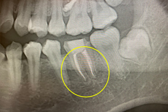マイクロエンド、歯根周囲掻爬（歯周外科）術後
