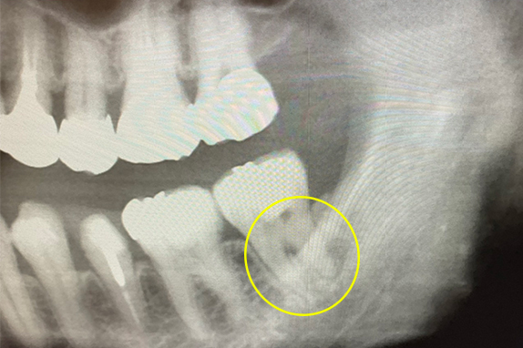 マイクロエンド（精密根管治療）、静脈内鎮静法（リラックス外来）術前