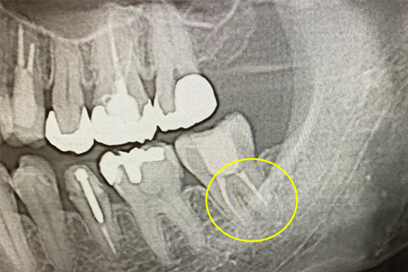 マイクロエンド（精密根管治療）、静脈内鎮静法（リラックス外来）術後