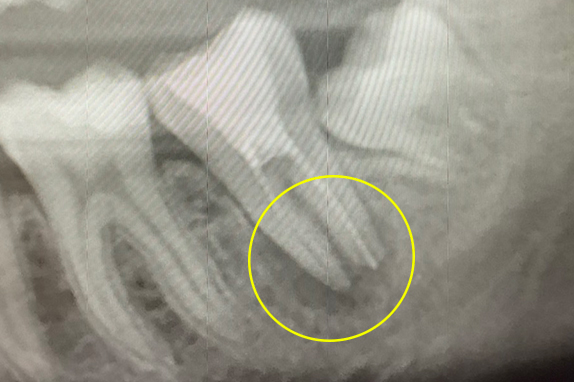 マイクロエンド、歯根周囲掻爬（歯周外科）術前