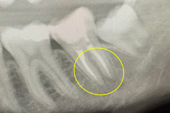 マイクロエンド、歯根周囲掻爬（歯周外科）術後