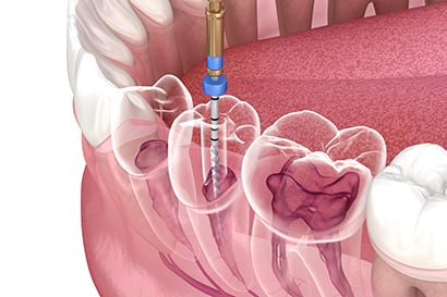 ニッケルチタンファイル