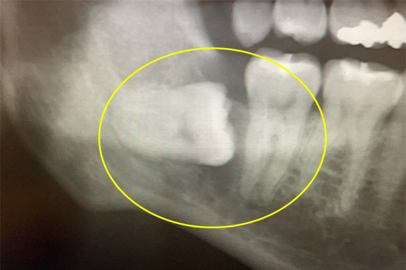 マイクロエンド+歯周基本治療術前