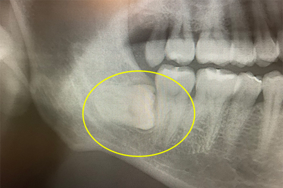 マイクロエンド+歯周基本治療術後